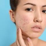 ⁠Eczema, psoriasis, rosacea
