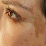Pigmentation & uneven skin tone
