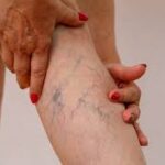 Varicose veins