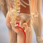 Slipped disc & sciatica