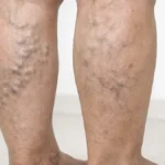 Varicose veins & circulation concerns